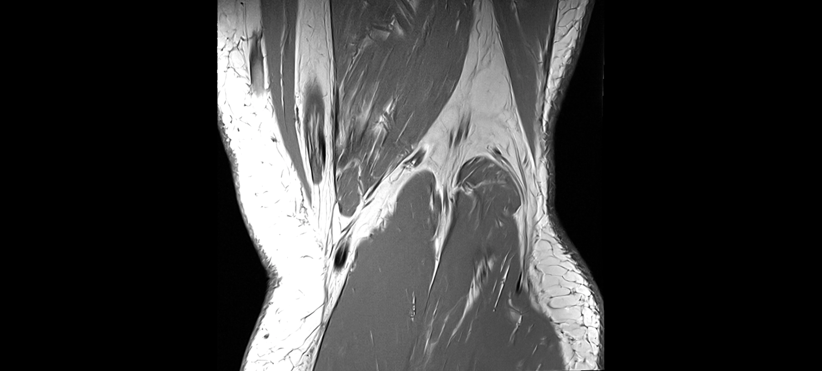 MRI coronal  ligaments cross sectional anatomy 3T  radiology  image-img-04001-00038.webp